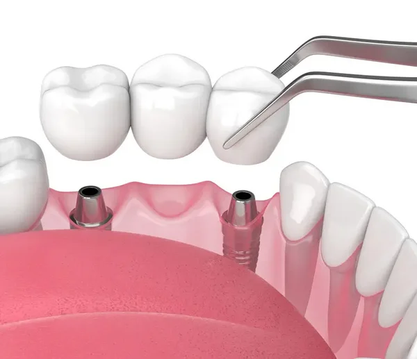 3D-Darstellung einer implantatgetragenen Br&uuml;cke im Unterkiefer